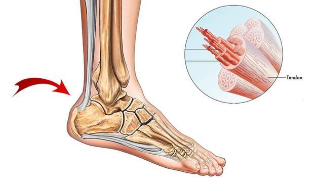 Aşil tendon yaralanması nasıl tedavi edilir? : Sağlık